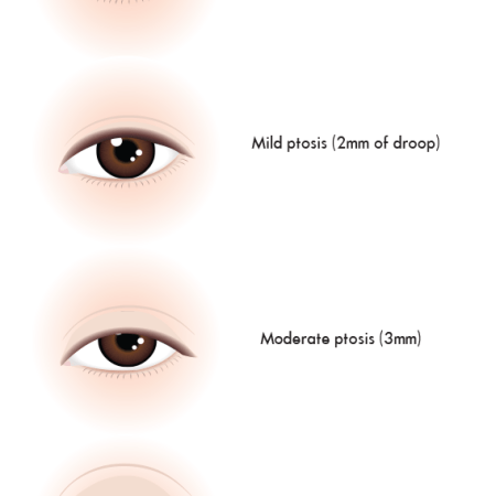 ptosis surgery droopy eyelids allure marginal reflex distance