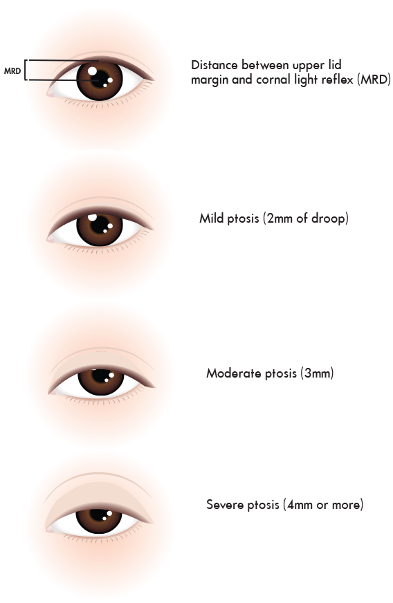 ptosis surgery droopy eyelids allure marginal reflex distance